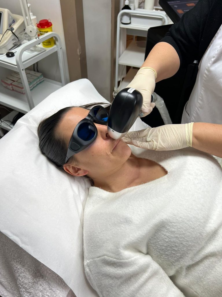 Épilation au laser de la moustache